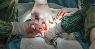 baby being born c section