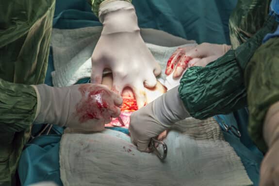 baby being born c-section