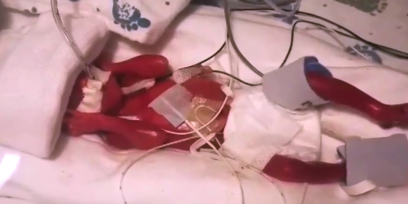 13-Ounce, 23 Week Baby Smallest To Survive At Des Moines Hospital