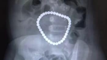 Surgeons-Remove-36-Magnetic-Balls-from-Intestines-of-One-Year-Old-Girl