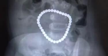 Surgeons-Remove-36-Magnetic-Balls-from-Intestines-of-One-Year-Old-Girl