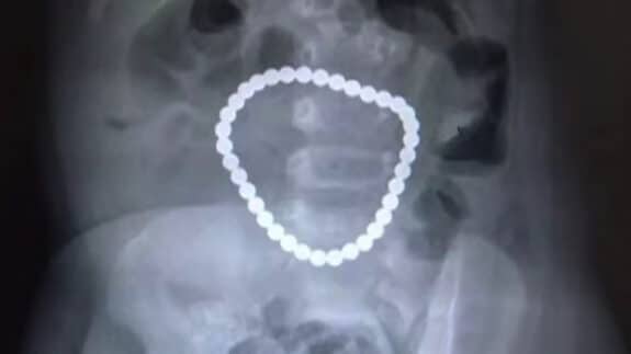 Surgeons Remove 36 Magnetic Balls from Intestines of One-Year-Old Girl