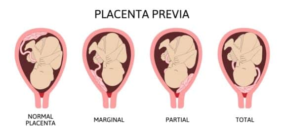 Placenta Previa