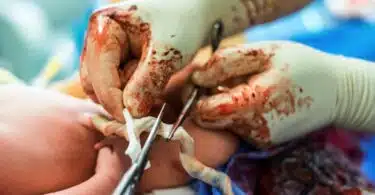 Cutting the umbilical cord between a newborn baby and placenta