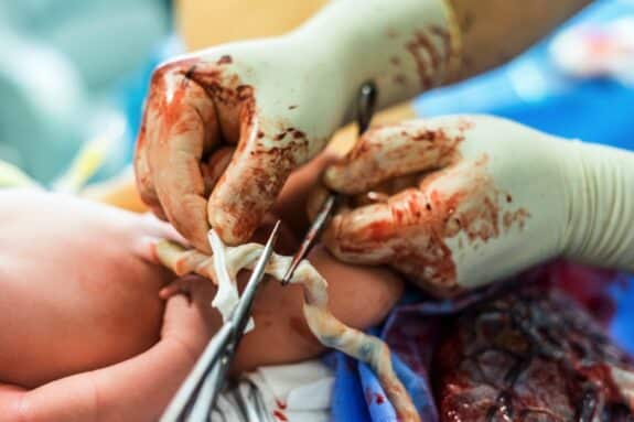  Cutting the umbilical cord between a newborn baby and placenta 