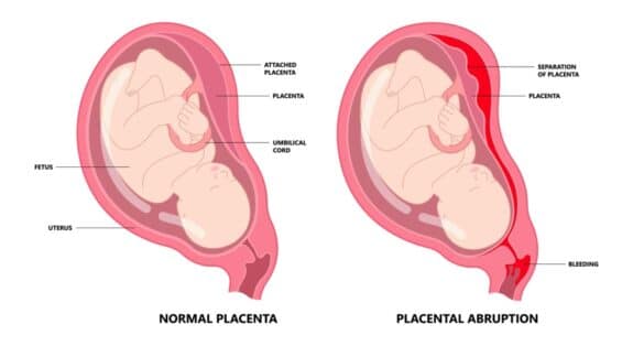 Placental Abruption