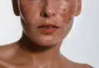 Hyperpigmentation of female skin, close-up of a part of the face on a white background, cosmetology, dermatology, skin care