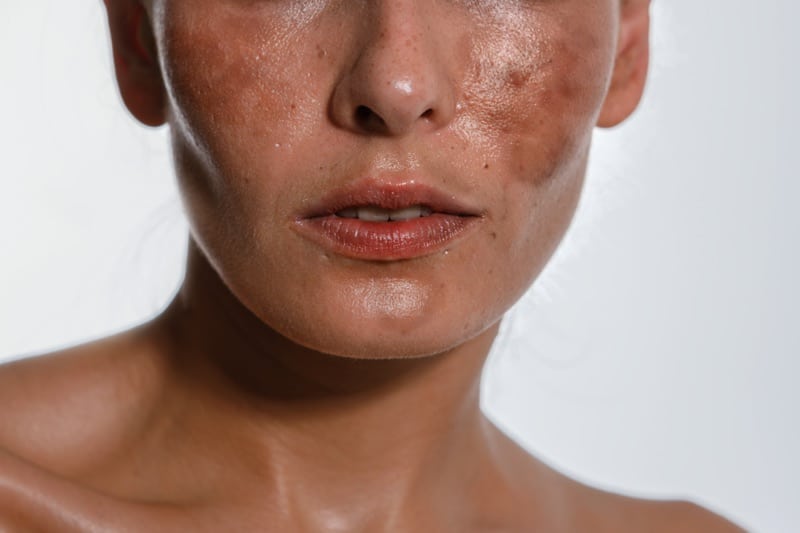 Pregnancy Mask Prevention and Treatment of Melasma in Pregnancy