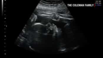 denver coleman ultrasound