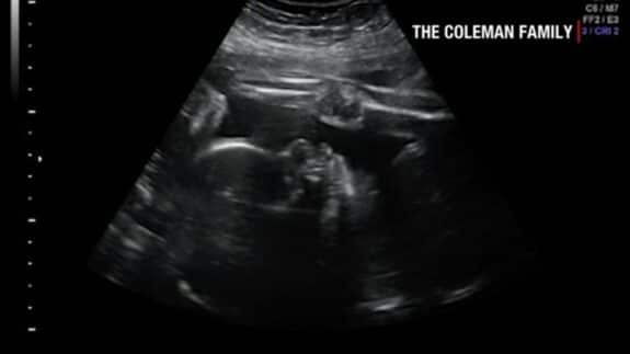 denver coleman ultrasound