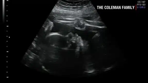 denver coleman ultrasound