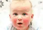 baby with eczema