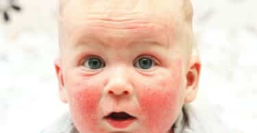 baby with eczema