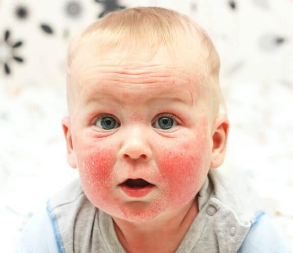 baby with eczema