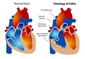 Tetralogy of Fallot