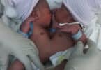 Azora and Azaria conjoined twins jamaica