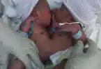 Azora and Azaria conjoined twins jamaica