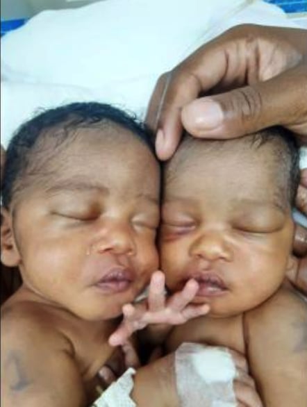 conjoined twins Azora and Azaria