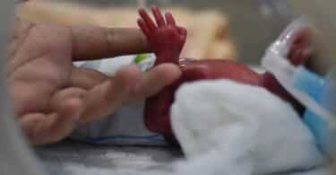 New born premature baby baby treated in incubator