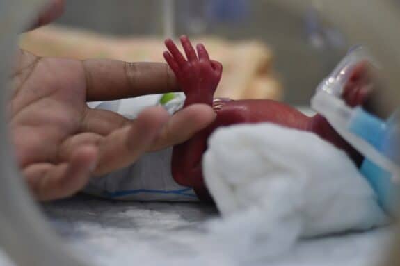 New born premature baby baby treated in incubator