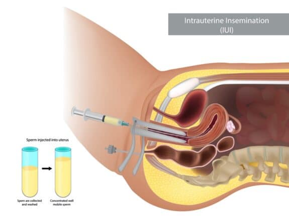 illustration artificial insemination. Intrauterine insemination IUI. Sperm injected into uterus
