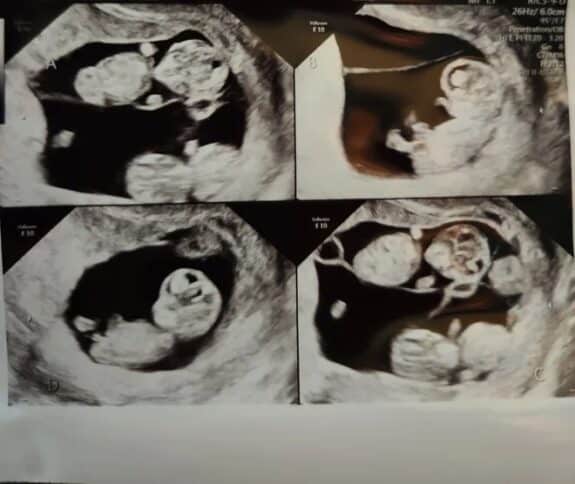 Jonathan and Mercedes Sandhus identical quadruplets ultrasound