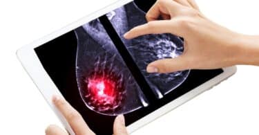 X-ray Digital Mammogram both breast MLO