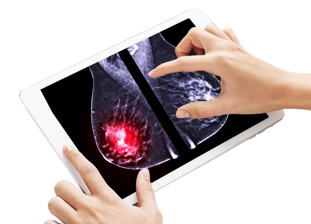 X-ray Digital Mammogram both breast MLO