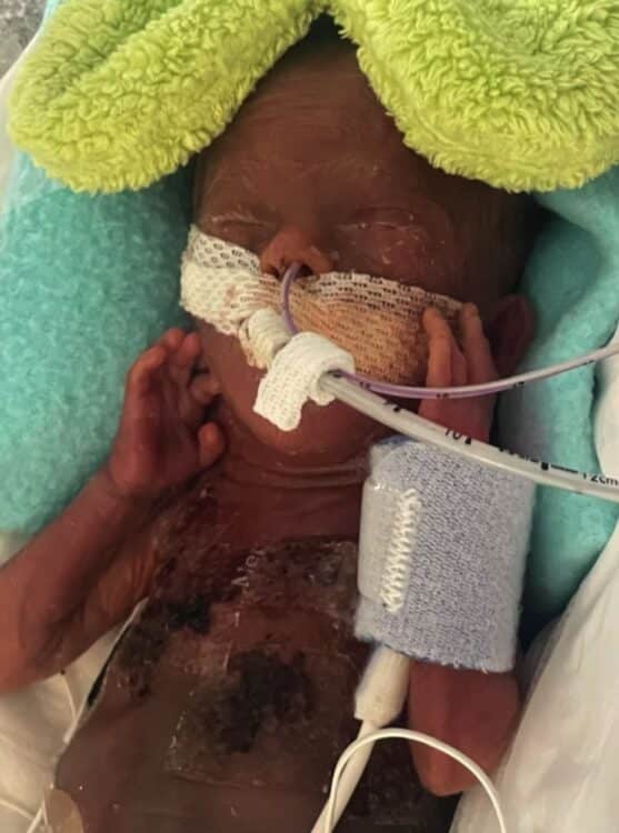 21 week premature baby Nash Keen