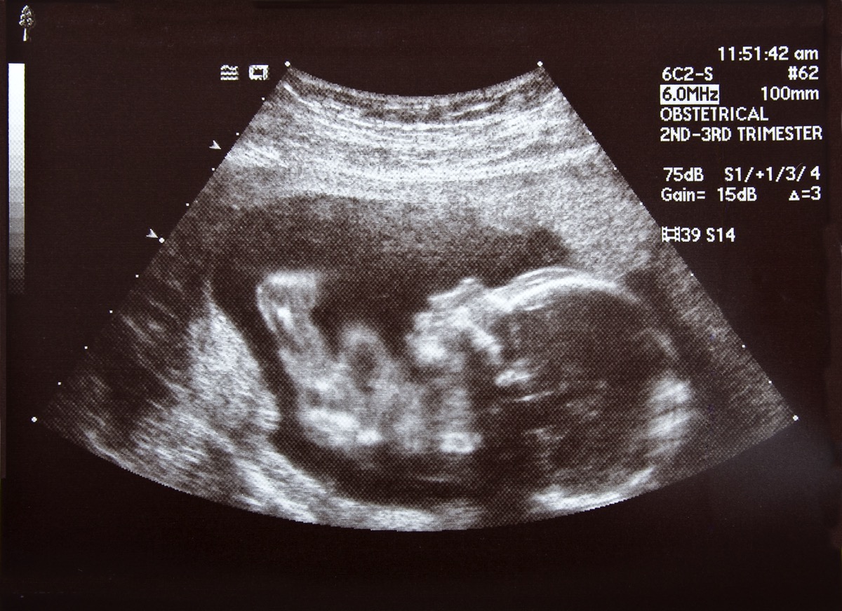 2nd trimester ultrasound