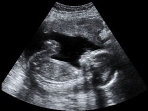 fetus in utero