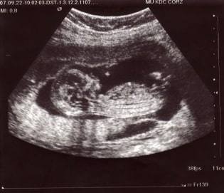 3 month old fetus