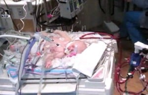 Baby Kaysen VandeWerken hooked up to ECMO machine