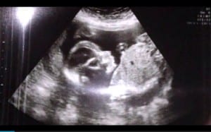 Baby Kaysen VandeWerken's ultrasound