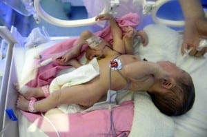 Baby born with 4 legs and 4 hands