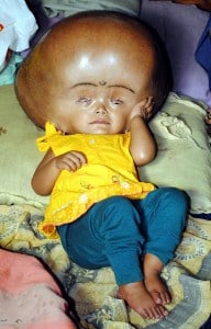 Baby roona hydrocephalus