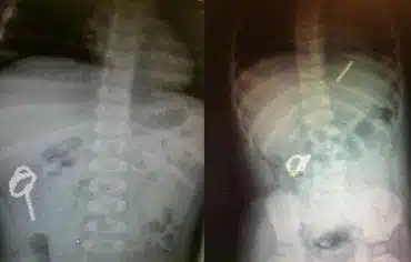 Ball bearings removed from toddler and X-rays showing their movement together