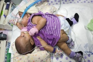 Conjoined twins Knatalye and Adeline Mata