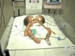 Conjoined twins born with one body and 2 heads