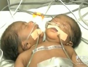 Conjoined twins born with one body and 2 heads