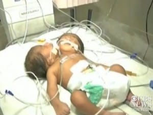 Conjoined twins born with one body and 2 heads in India