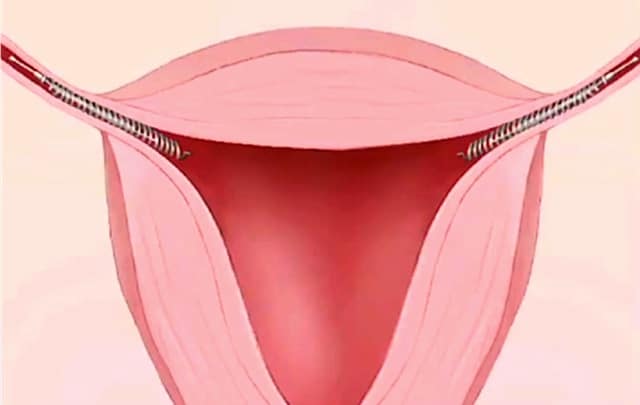 Essure Birth Control installed