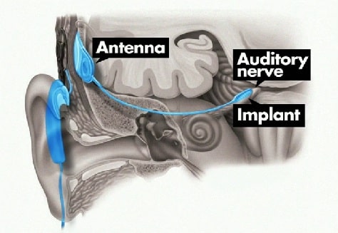 Grayson Clamp's procedure