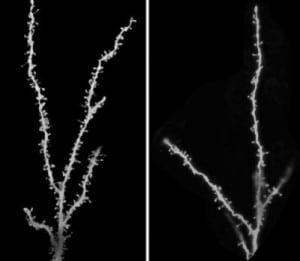 Image shows neurons from a child with autism(L), and control brains  Guomei Tang, PhD and Mark S