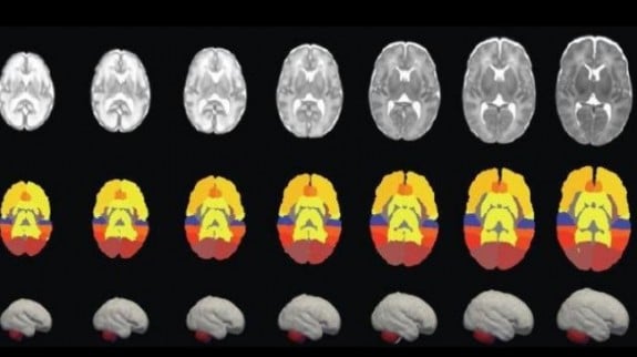 Infant brain development