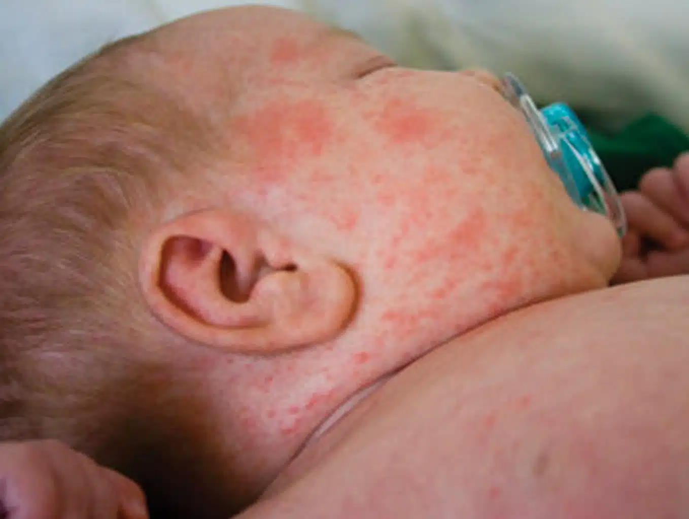 Measles baby