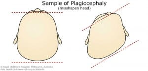 Positional plagiocephaly