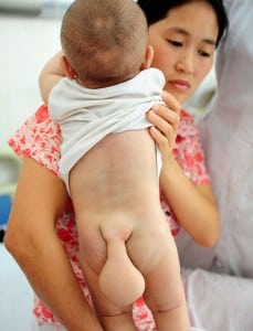 Rare Form of Spinal Bifida Xiao Wei