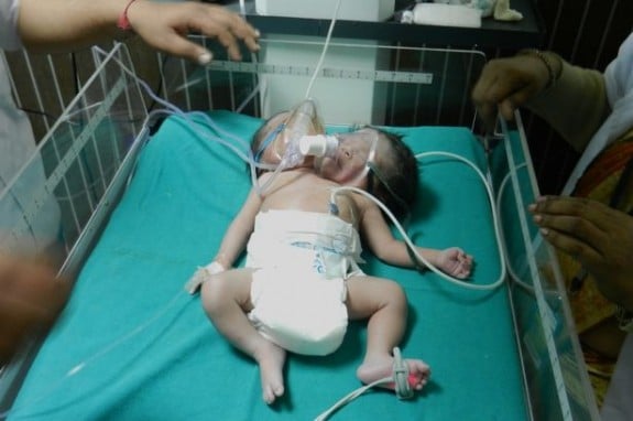 Rare dicephalic parapagus conjoined twins India