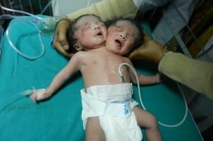 Rare dicephalic parapagus conjoined twins born India